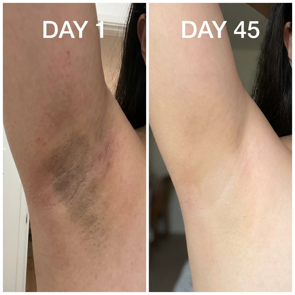 Before After Day 1 Day 45 - Filipino