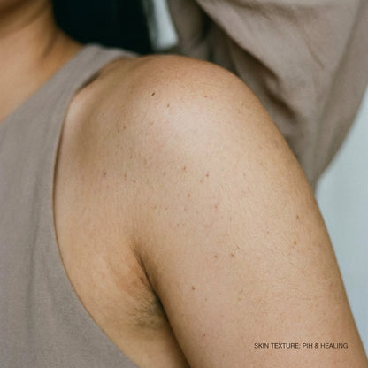 Post-inflammatory hyperpigmentation